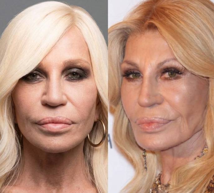 Montagem de fotos de antes e depois de cirurgias plasticas de donatella versace.